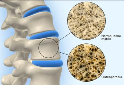 Osteoporosis | Infonet Biovision Home.