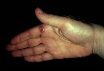 Orf lesion on human hand Orf lesion on human hand