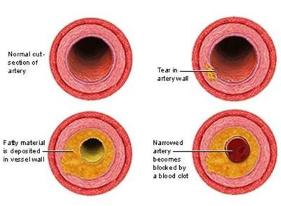 Cholesterol