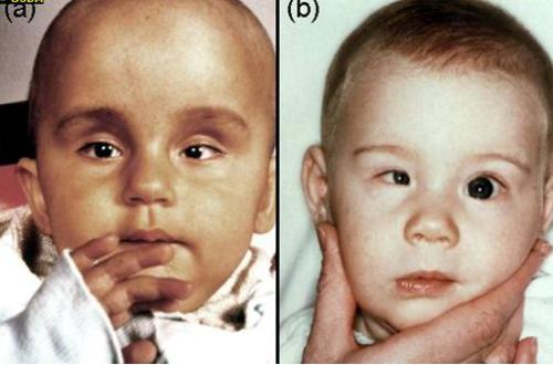 Signs of Toxoplasmosis in children