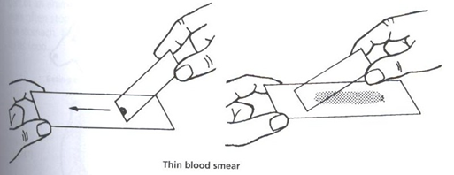 Thin blood smear