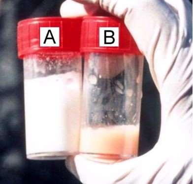 Milk sample: (A) normal milk, (B) mastitis - discoloured, yellowish, here also tinged with blood